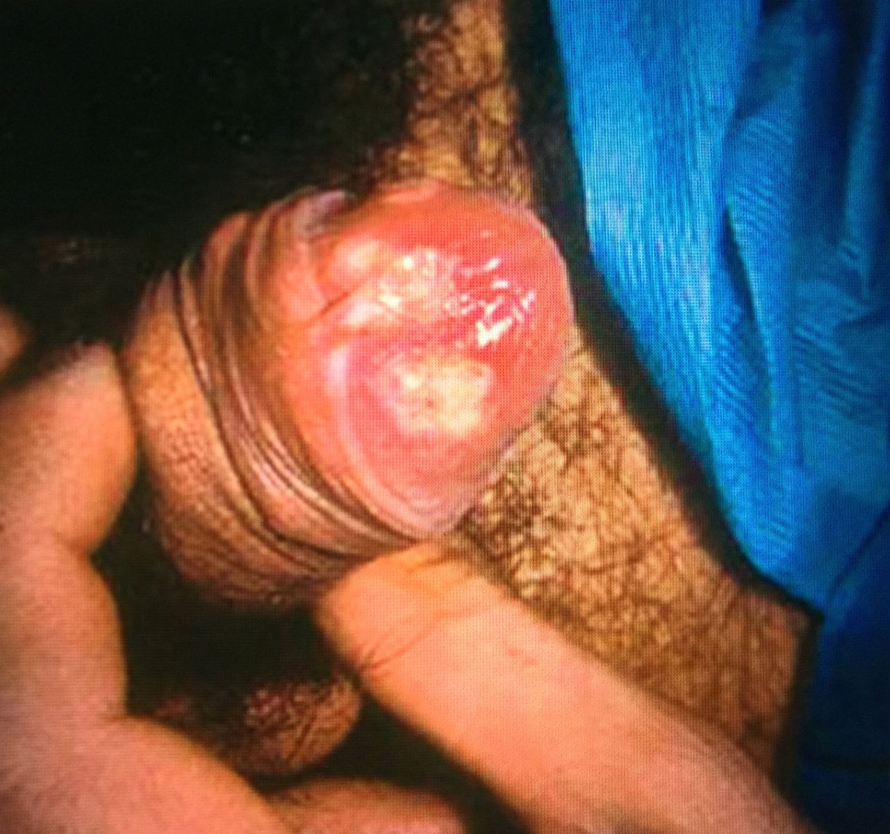 можно ли заразиться хламидиями от минета фото 44